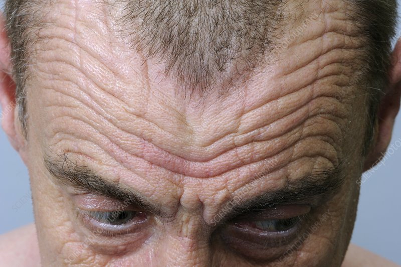 Furrowed / wrinkled forehead